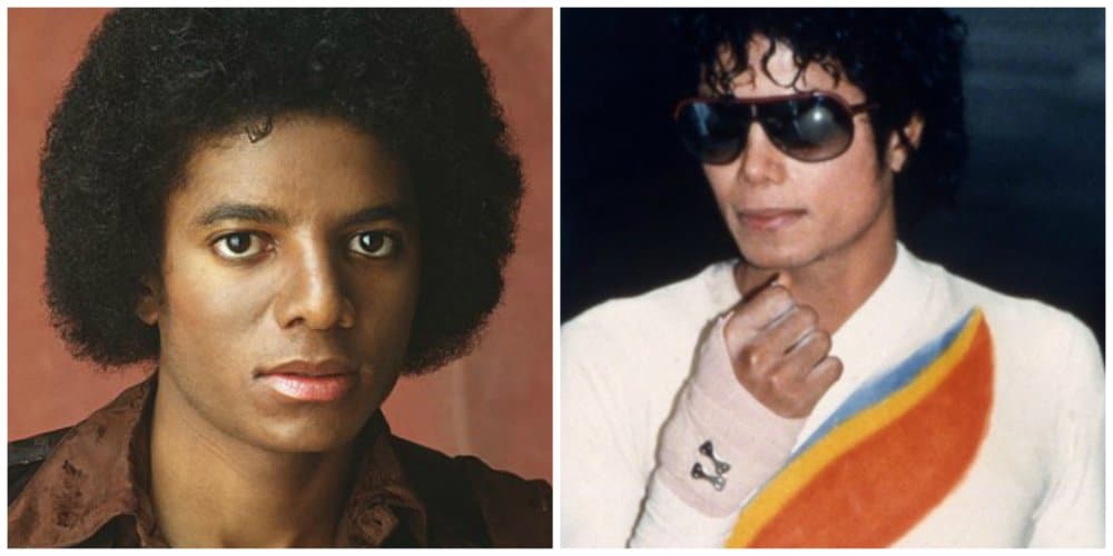 michael jackson skin condition