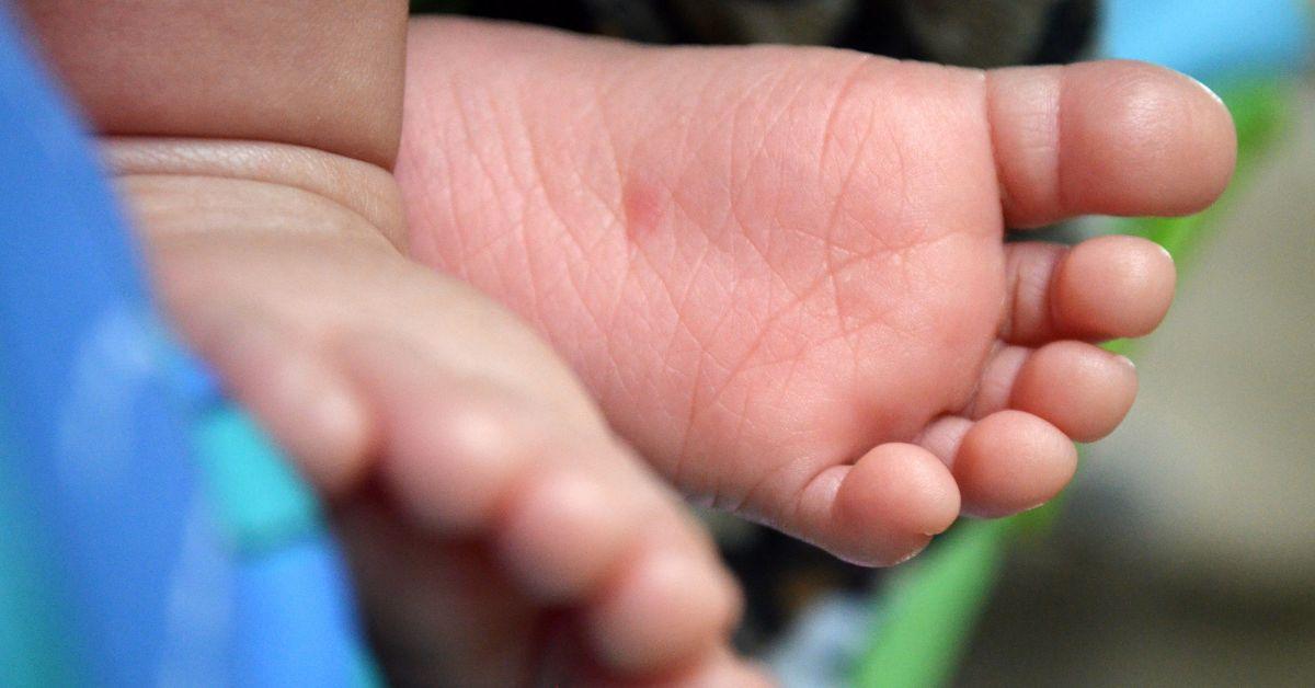Understanding Metatarsus Adductus in Babies: Causes, Symptoms, and Severity Levels